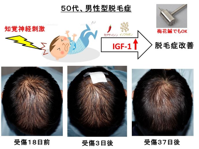 円形脱毛症　病院